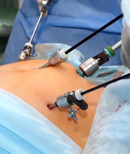 laparoscopic-hysterectomy